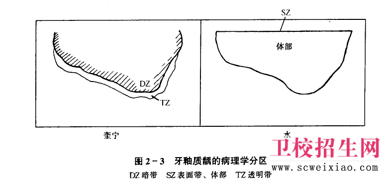 牙釉质龋的显微结构