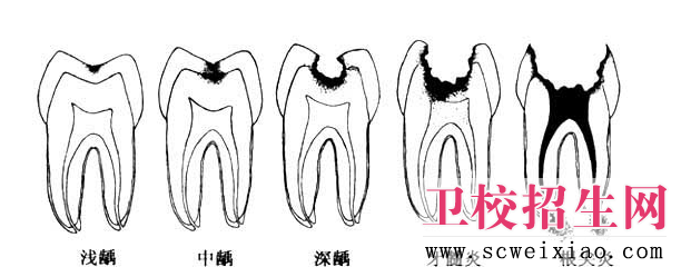 牙髓病护理