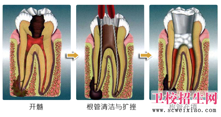 牙髓炎