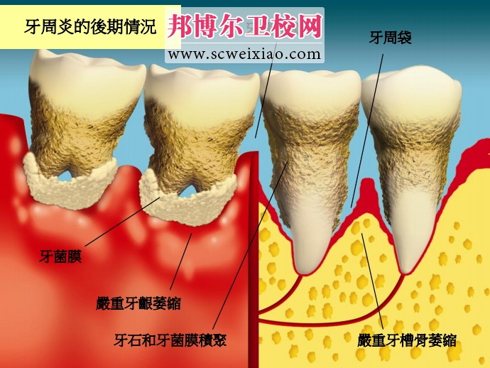 牙周炎